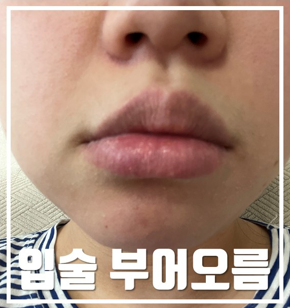 입술이 부어오른 모습 — 서울 바로한의원 초음파 약침·도침