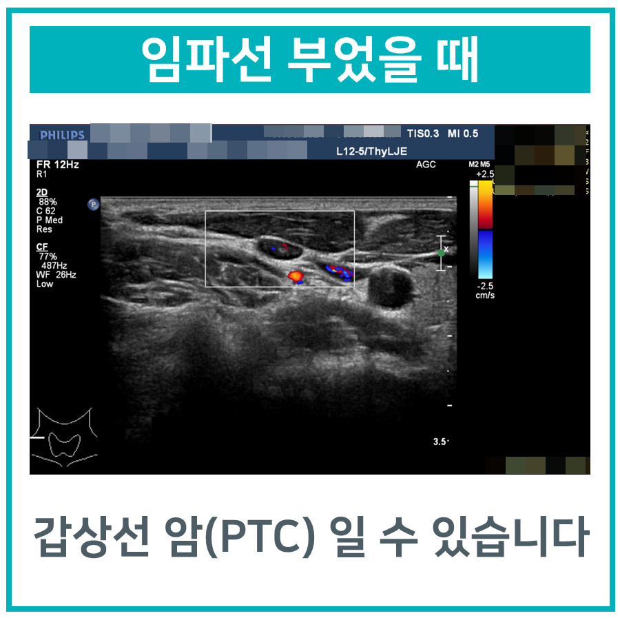 목 부위의 초음파 사진으로, 혈류가 보이는 임파선 또는 갑상선 조직이 보인다 — 초음파 정밀 진단 | 서울 바로한의원 초음파 약침·도침·침도