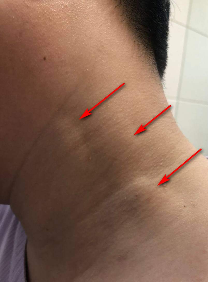 목 옆 피부 아래에 부어 보이는 멍울 세 개를 빨간 화살표가 가리키고 있는 모습 — 서울 바로한의원 초음파 약침·도침