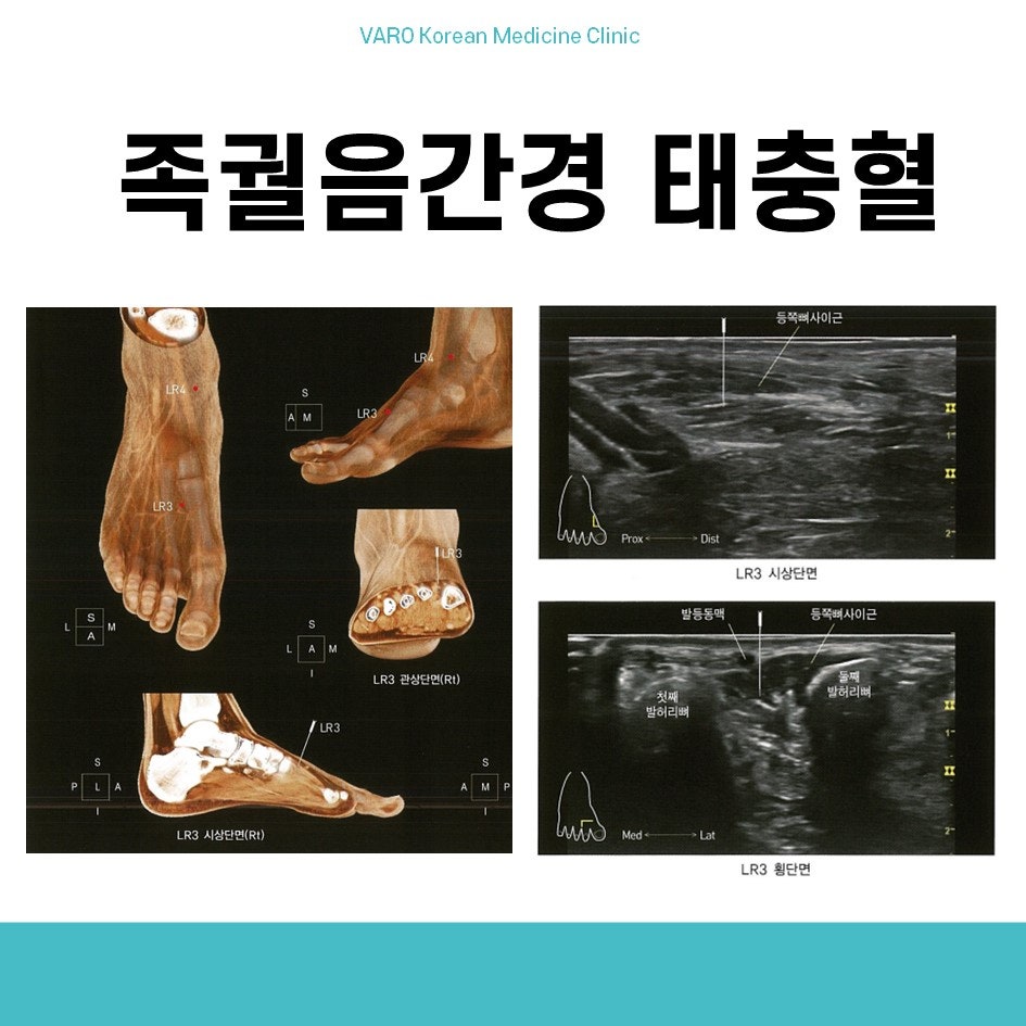 발의 해부학적 구조와 태충혈(LR3) 위치를 보여주는 그림 및 태충혈 주변의 초음파 영상 — 초음파 정밀 진단 | 서울 바로한의원 초음파 약침·도침·침도