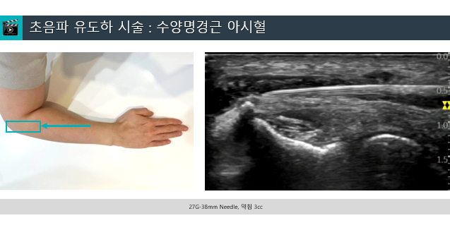 팔꿈치에 초음파 유도 침 시술을 하는 모습과 해당 부위의 초음파 영상 — 초음파 유도하 약침 시술 | 서울 바로한의원