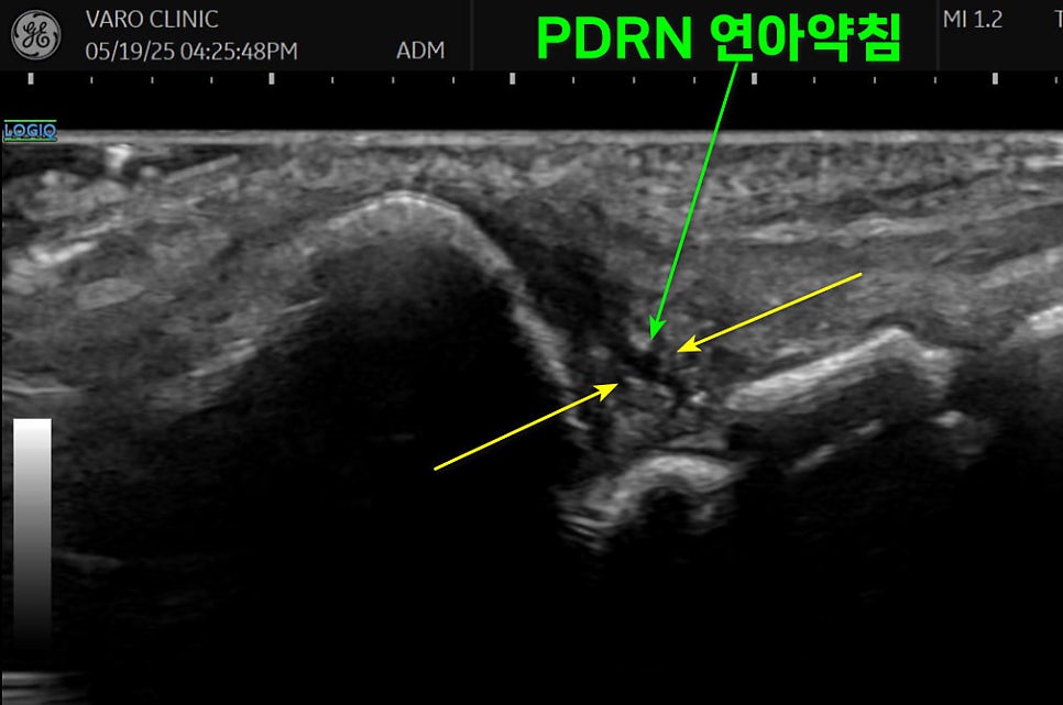 PDRN 연아약침을 TFCC 주변부에 주입하는 초음파 영상 — 초음파 유도하 약침 시술 | 서울 바로한의원