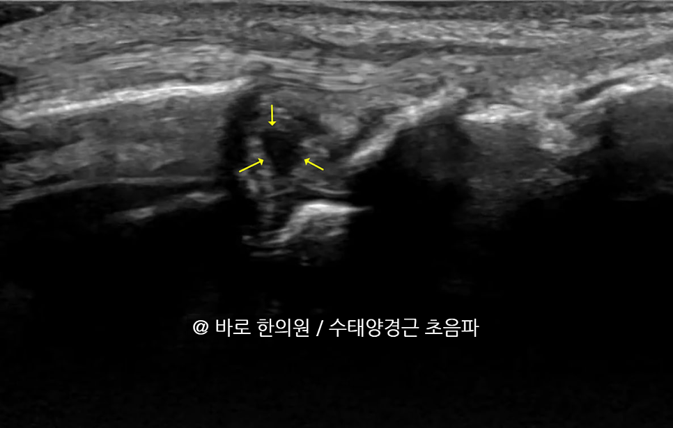 손목 삼각섬유연골복합체(TFCC) 부위의 초음파 영상에 노란색 화살표가 표시되어 있습니다 — 초음파 정밀 진단 | 서울 바로한의원 초음파 약침·도침·침도