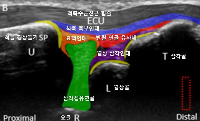 손목 삼각섬유연골복합체와 주변 인대, 뼈를 보여주는 초음파 사진 — 초음파 정밀 진단 | 서울 바로한의원 초음파 약침·도침·침도