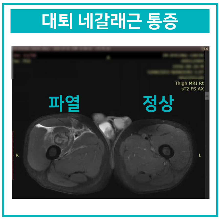 대퇴 네갈래근 파열 부위와 정상 부위를 비교한 허벅지 MRI 사진 — 서울 바로한의원 초음파 약침·도침