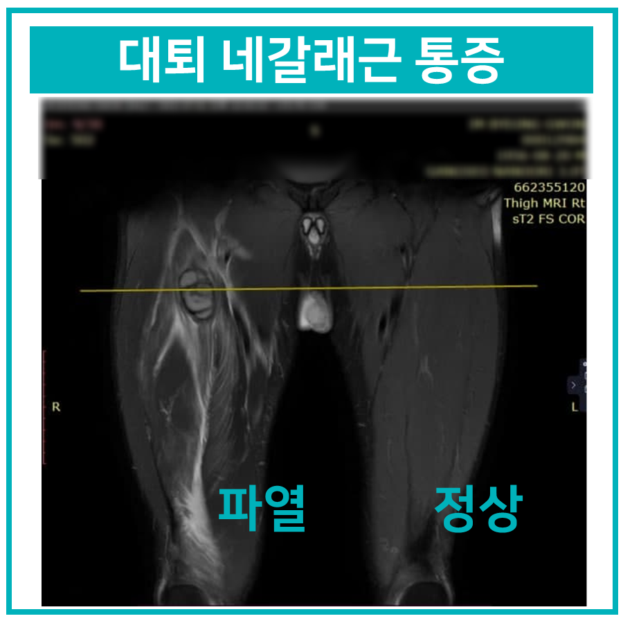 대퇴 네갈래근 통증을 보여주는 허벅지 MRI 사진으로, 왼쪽 허벅지는 파열된 상태이고 오른쪽 허벅지는 정상 상태이다 — 서울 바로한의원 초음파 약침·도침
