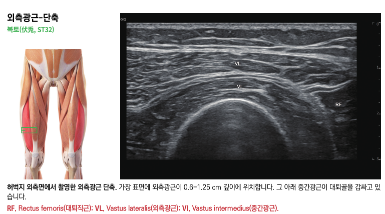 허벅지 외측광근의 해부학적 위치를 나타내는 그림과 해당 부위의 초음파 영상 — 초음파 정밀 진단 | 서울 바로한의원 초음파 약침·도침·침도