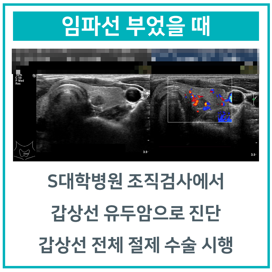 갑상선 유두암 진단과 수술 내용을 설명하는 흑백 및 컬러 도플러 초음파 사진 — 초음파 정밀 진단 | 서울 바로한의원 초음파 약침·도침·침도