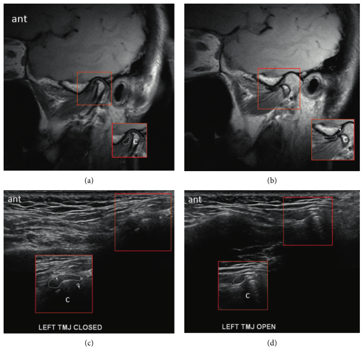 턱관절의 닫힌 상태와 열린 상태를 보여주는 MRI 및 초음파 영상 — 초음파 정밀 진단 | 서울 바로한의원 초음파 약침·도침·침도