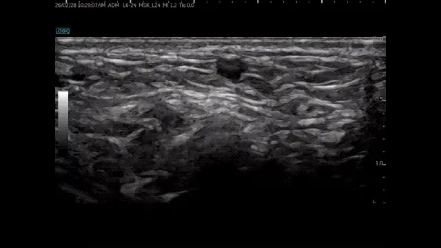 발가락 부위의 내부 조직과 액체 저류가 보이는 초음파 사진 — 초음파 정밀 진단 | 서울 바로한의원 초음파 약침·도침·침도