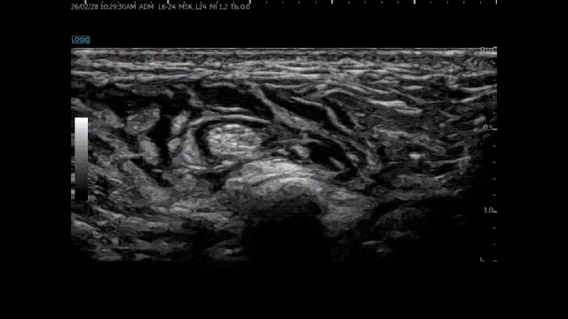 발가락 또는 발 부위의 내부 구조를 나타내는 초음파 사진 — 초음파 정밀 진단 | 서울 바로한의원 초음파 약침·도침·침도