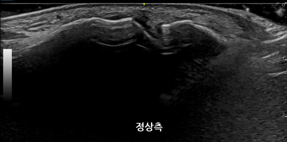 발가락의 정상적인 내부 구조를 보여주는 초음파 사진 — 초음파 정밀 진단 | 서울 바로한의원 초음파 약침·도침·침도