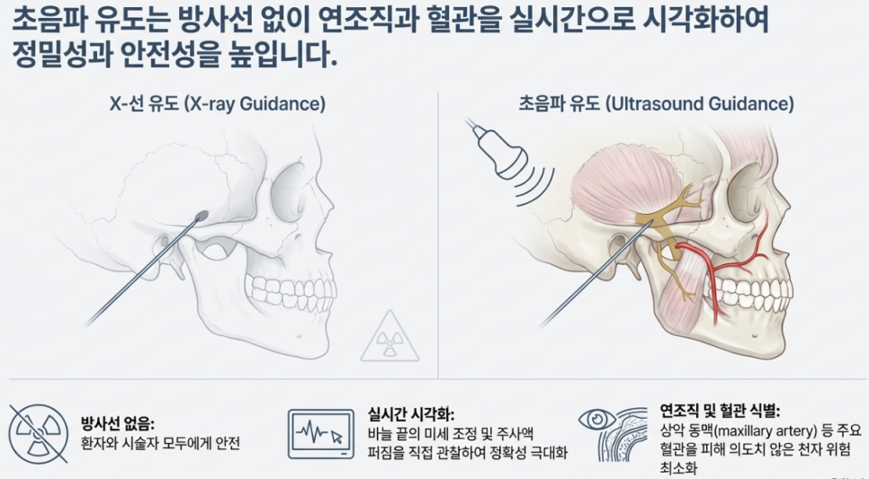 엑스레이 유도와 초음파 유도를 비교하는 그림으로, 초음파 유도 시 삼차신경 부위의 연조직, 신경, 혈관을 보며 주사 바늘이 삽입되는 모습을 보여줍니다 — 초음파 유도하 약침 시술 | 서울 바로한의원