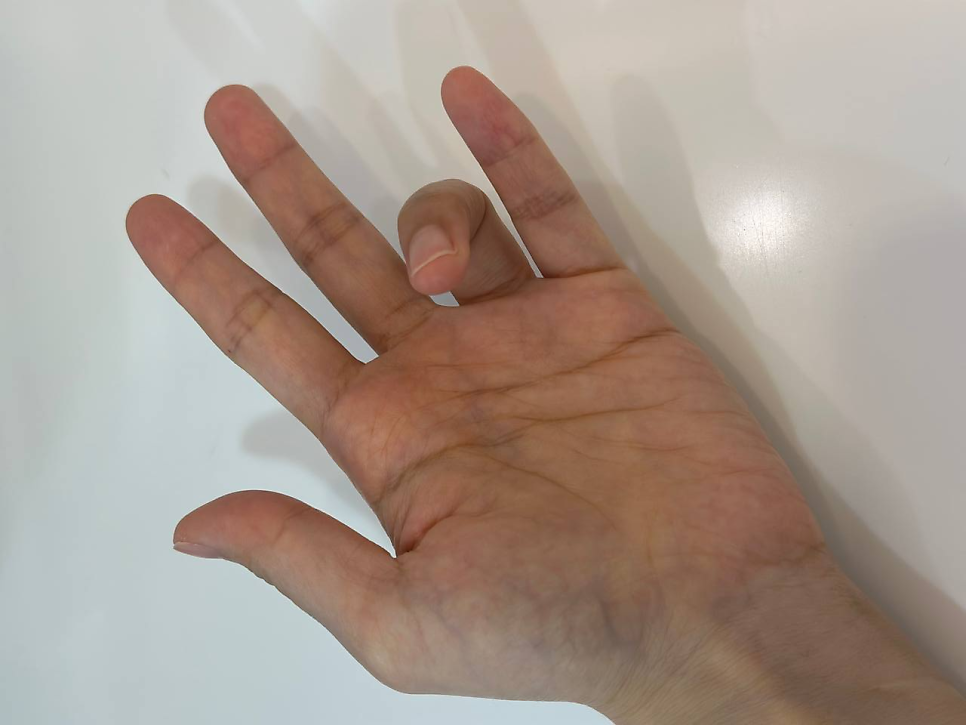 약지를 굽히고 다른 손가락은 편 손바닥 — 서울 바로한의원 초음파 약침·도침