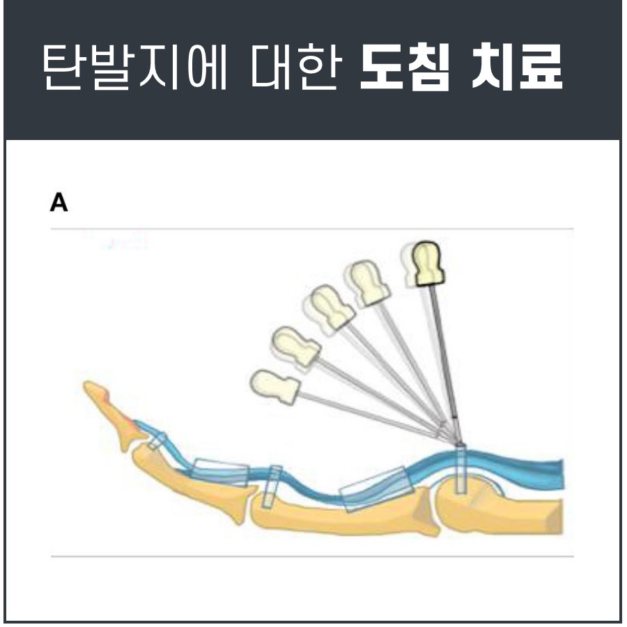 방아쇠 수지 증후군 치료를 위해 손가락 힘줄에 도침을 시술하는 그림 — 초음파 유도하 약침 시술 | 서울 바로한의원