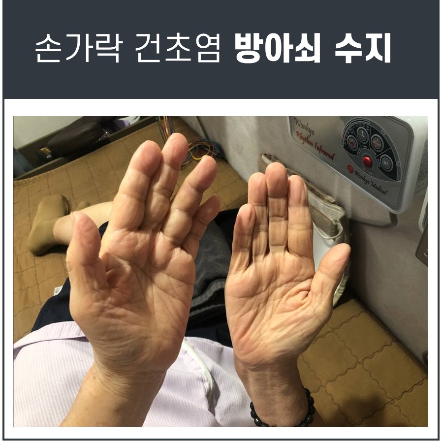 환자의 두 손바닥을 위로 향하게 하여 찍은 사진으로, 손바닥에 주름이 보인다 — 서울 바로한의원 초음파 약침·도침