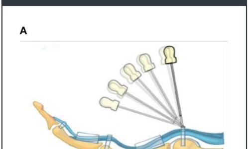 손가락 관절 부위에 주사 바늘이 삽입되는 모습을 뼈와 힘줄 구조와 함께 보여주는 삽화 — 초음파 유도하 약침 시술 | 서울 바로한의원