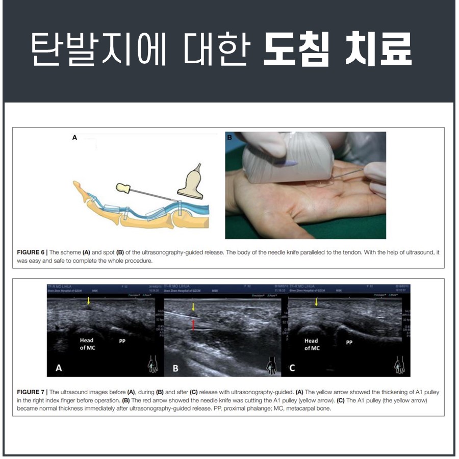 초음파 유도하에 도침으로 방아쇠 수지를 치료하는 과정의 도식과 실제 시술 사진, 그리고 시술 전후 및 시술 중 A1 활차를 절개하는 초음파 영상 — 초음파 유도하 약침 시술 | 서울 바로한의원