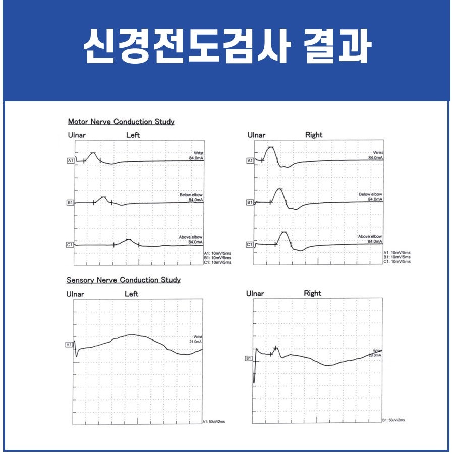 좌우 척골 신경의 운동 및 감각 신경 전도 검사 결과 그래프 — 초음파 약침·도침 임상 논문 | 서울 바로한의원