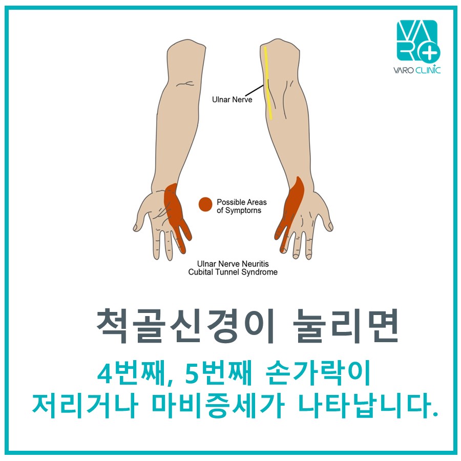 척골신경의 경로와 척골신경 압박 시 4, 5번째 손가락에 나타나는 저림 증상 부위를 보여주는 그림 — 서울 바로한의원 초음파 약침·도침