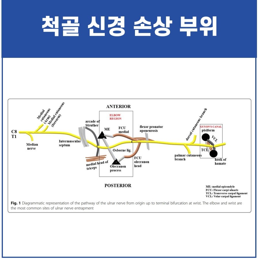 척골 신경의 경로와 팔꿈치 및 손목 부위의 신경 포착 지점을 보여주는 도식도 — 서울 바로한의원 초음파 약침·도침