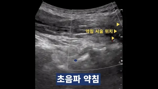 약침 시술 위치를 표시한 초음파 영상 — 초음파 유도하 약침 시술 | 서울 바로한의원