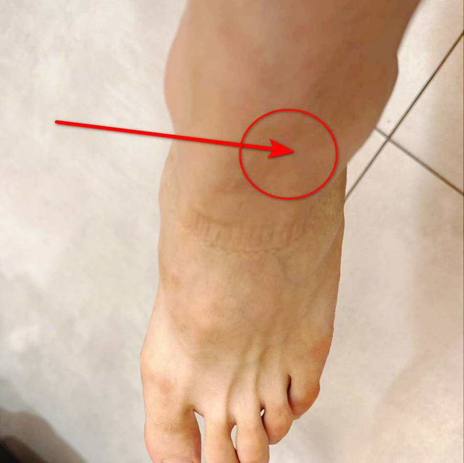 발과 발목 부위를 찍은 사진으로, 빨간 화살표가 발목 위쪽 한 지점을 가리키고 있다 — 서울 바로한의원 초음파 약침·도침