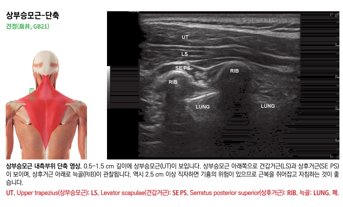 상부 승모근 해부도와 해당 부위의 초음파 영상이 함께 있는 이미지로, 초음파 영상에는 승모근, 견갑거근, 상후거근, 늑골, 폐가 표시되어 있다 — 초음파 정밀 진단 | 서울 바로한의원 초음파 약침·도침·침도