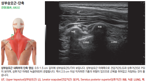 상부 승모근 해부도와 목 부위 초음파 영상 — 초음파 정밀 진단 | 서울 바로한의원 초음파 약침·도침·침도