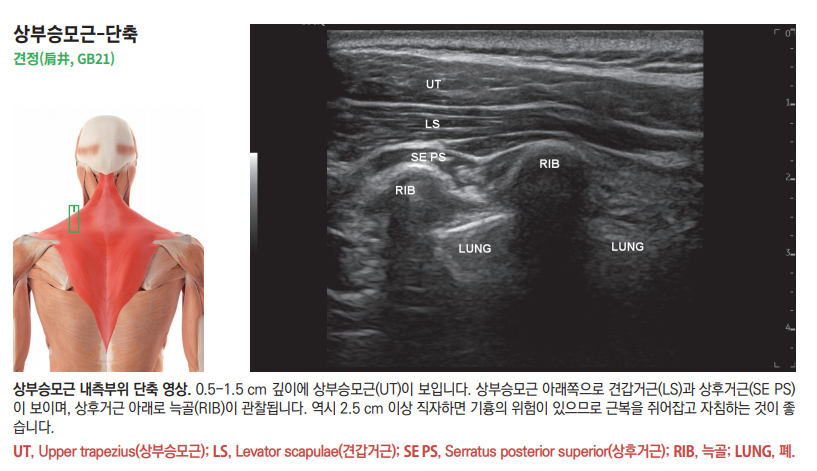 상부 승모근의 해부학적 그림과 해당 부위의 초음파 영상으로, 승모근, 견갑거근, 상후거근, 늑골, 폐가 표시되어 있다 — 초음파 정밀 진단 | 서울 바로한의원 초음파 약침·도침·침도