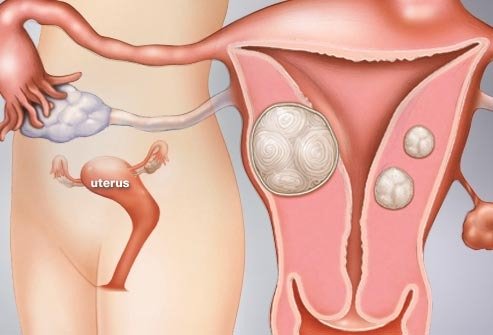 재발하는 자궁근종 치료 잘하는 [화곡역 여성 한의원]