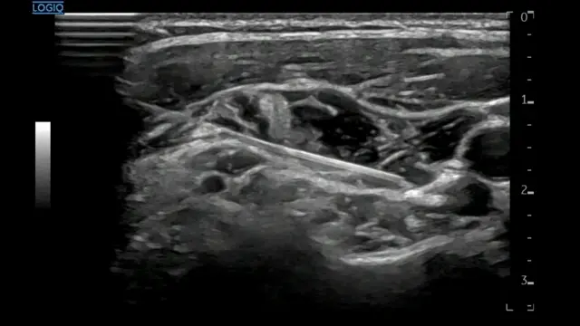 초음파 화면에 조직 내로 삽입된 주사 바늘이 보이는 모습 — 초음파 유도하 약침 시술 | 서울 바로한의원
