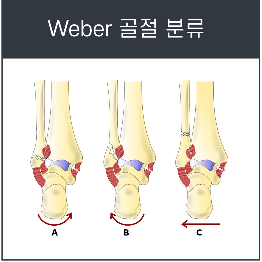 발목 비골 골절의 Weber 분류에 따른 A, B, C 세 가지 유형을 보여주는 그림 — 서울 바로한의원 초음파 약침·도침