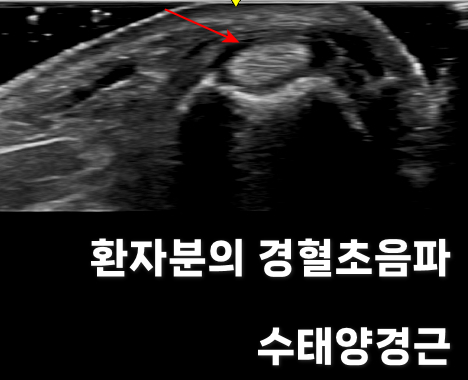 손목 부위의 경혈 초음파 사진으로, 붉은 화살표가 특정 구조물을 가리키고 있다 — 초음파 정밀 진단 | 서울 바로한의원 초음파 약침·도침·침도
