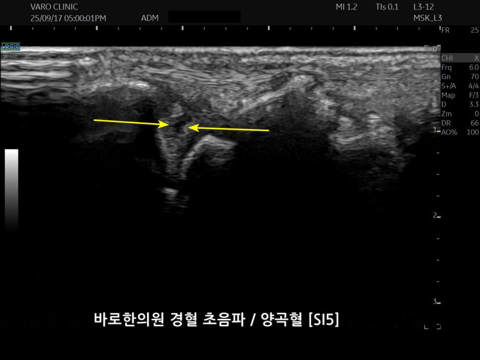 손목 경혈 부위의 초음파 영상으로, 노란색 화살표가 특정 지점을 표시하고 있다 — 초음파 정밀 진단 | 서울 바로한의원 초음파 약침·도침·침도