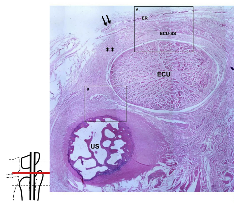 손목 척측수근신근(ECU) 힘줄과 힘줄집, 척골(US)의 단면을 보여주는 현미경 사진 — 서울 바로한의원 초음파 약침·도침