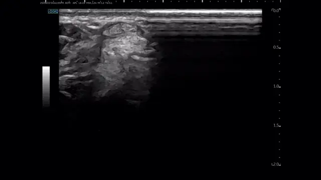 손목 척측수근신근 부위의 초음파 영상 — 초음파 정밀 진단 | 서울 바로한의원 초음파 약침·도침·침도