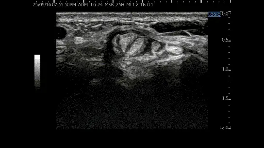 손목 부위의 힘줄과 주변 연부 조직을 보여주는 초음파 영상 — 초음파 정밀 진단 | 서울 바로한의원 초음파 약침·도침·침도