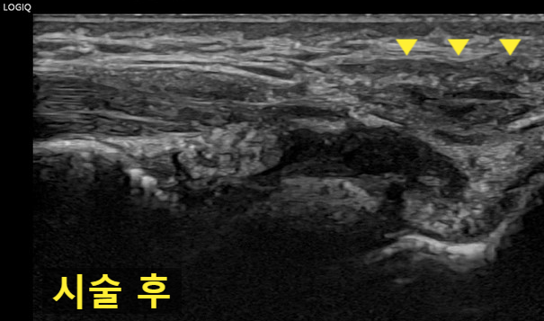 시술 후 손목 부위의 초음파 사진으로, 노란색 화살표가 조직을 표시하고 있습니다 — 초음파 유도하 약침 시술 | 서울 바로한의원