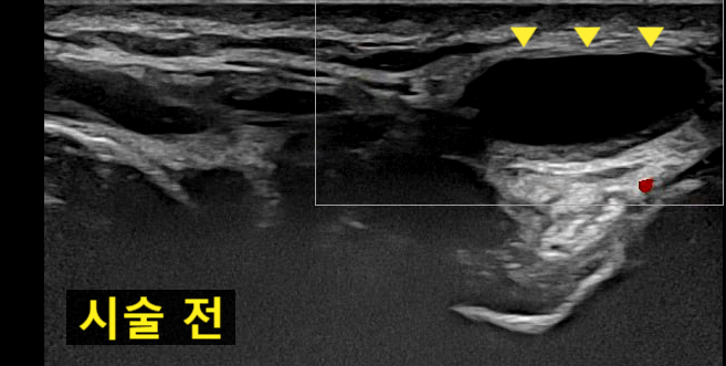 시술 전 손목 결절종 초음파 사진 — 초음파 유도하 약침 시술 | 서울 바로한의원