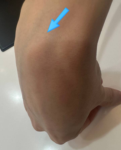 손목 부위에 파란 화살표가 가리키는 융기 — 서울 바로한의원 초음파 약침·도침