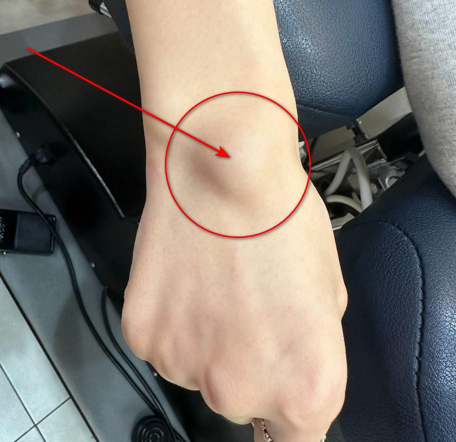 손목 등 쪽에 붉은 원과 화살표로 표시된 결절종이 있는 모습 — 서울 바로한의원 초음파 약침·도침