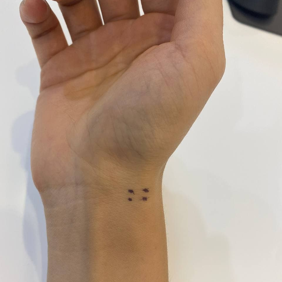 손목에 보라색 점 네 개가 표시된 모습 — 서울 바로한의원 초음파 약침·도침