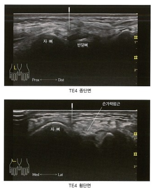 손목 결절종에 침이 삽입된 초음파 사진 — 초음파 정밀 진단 | 서울 바로한의원 초음파 약침·도침·침도