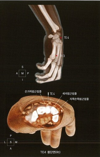 오른쪽 손목과 손의 뼈를 측면에서 본 3D 이미지와 TE4 지점의 횡단면 이미지. 횡단면에는 뼈와 손가락폄근힘줄, 새끼폄근힘줄, 자쪽손목폄근힘줄이 표시되어 있다 — 서울 바로한의원 초음파 약침·도침