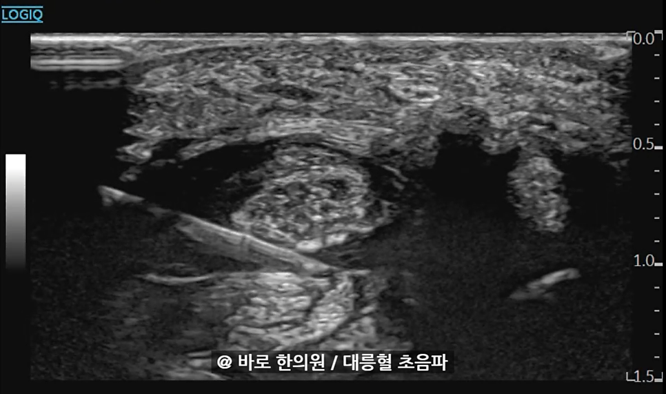 손목 부위의 초음파 영상에서 조직 내에 삽입된 주사 바늘이 보인다 — 초음파 유도하 약침 시술 | 서울 바로한의원