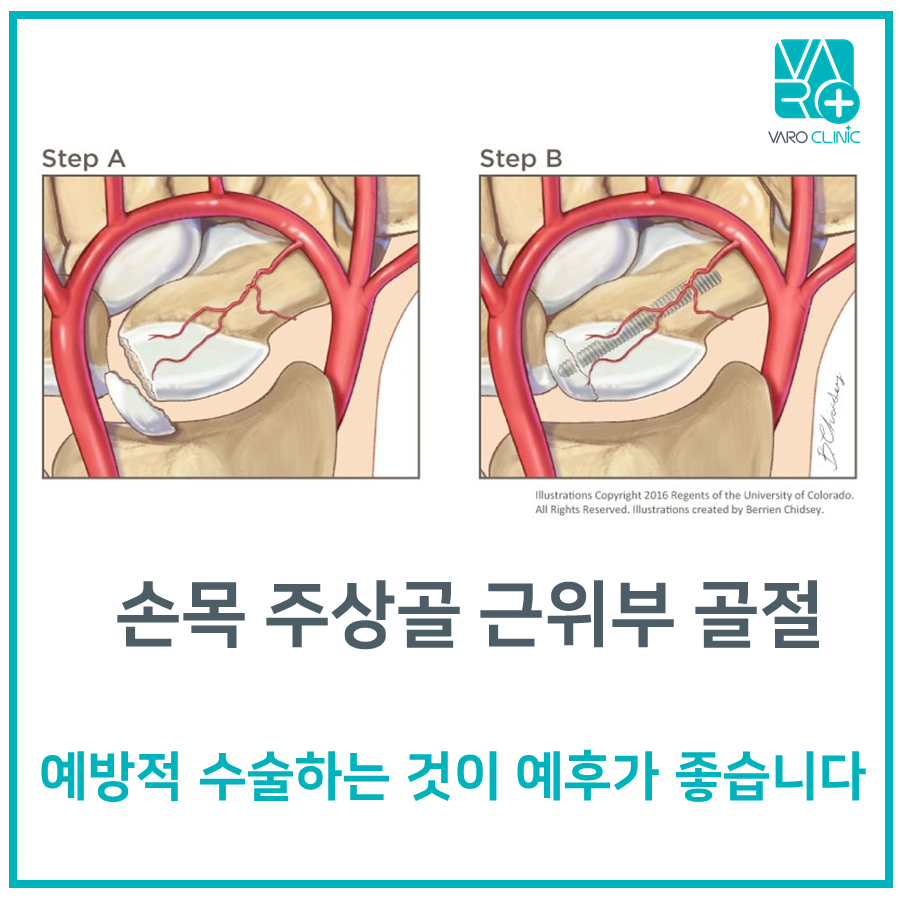 손목 주상골 골절 전후를 보여주는 삽화로, 골절된 뼈와 혈관, 그리고 나사로 고정된 수술 후 모습이 단계별로 묘사되어 있다 — 서울 바로한의원 초음파 약침·도침