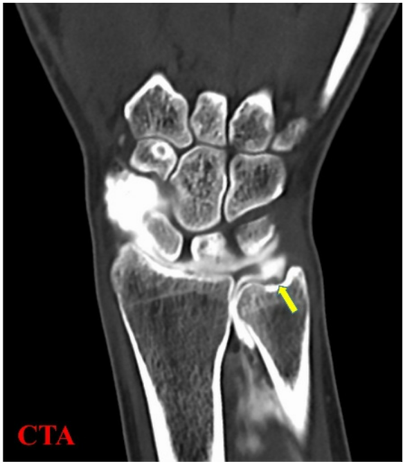 손목 뼈 구조를 보여주는 CT 스캔 이미지이며, 노란색 화살표가 손목의 척골 부위를 가리키고 있습니다 — 서울 바로한의원 초음파 약침·도침