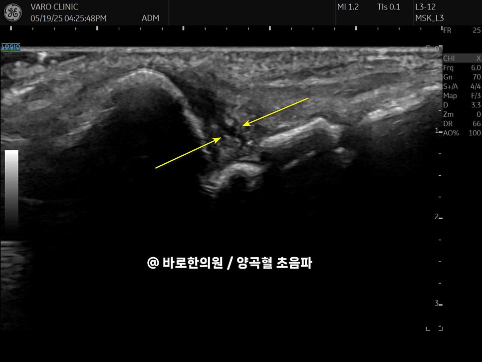 손목 삼각섬유연골(TFCC) 부위를 가리키는 노란색 화살표가 있는 초음파 사진 — 초음파 정밀 진단 | 서울 바로한의원 초음파 약침·도침·침도