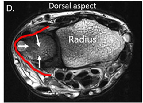 손목의 등쪽을 촬영한 MRI 사진으로, 요골이 표시되어 있고 척골과 손목뼈 사이의 특정 부위에 붉은 선과 흰색 화살표가 있습니다 — 서울 바로한의원 초음파 약침·도침
